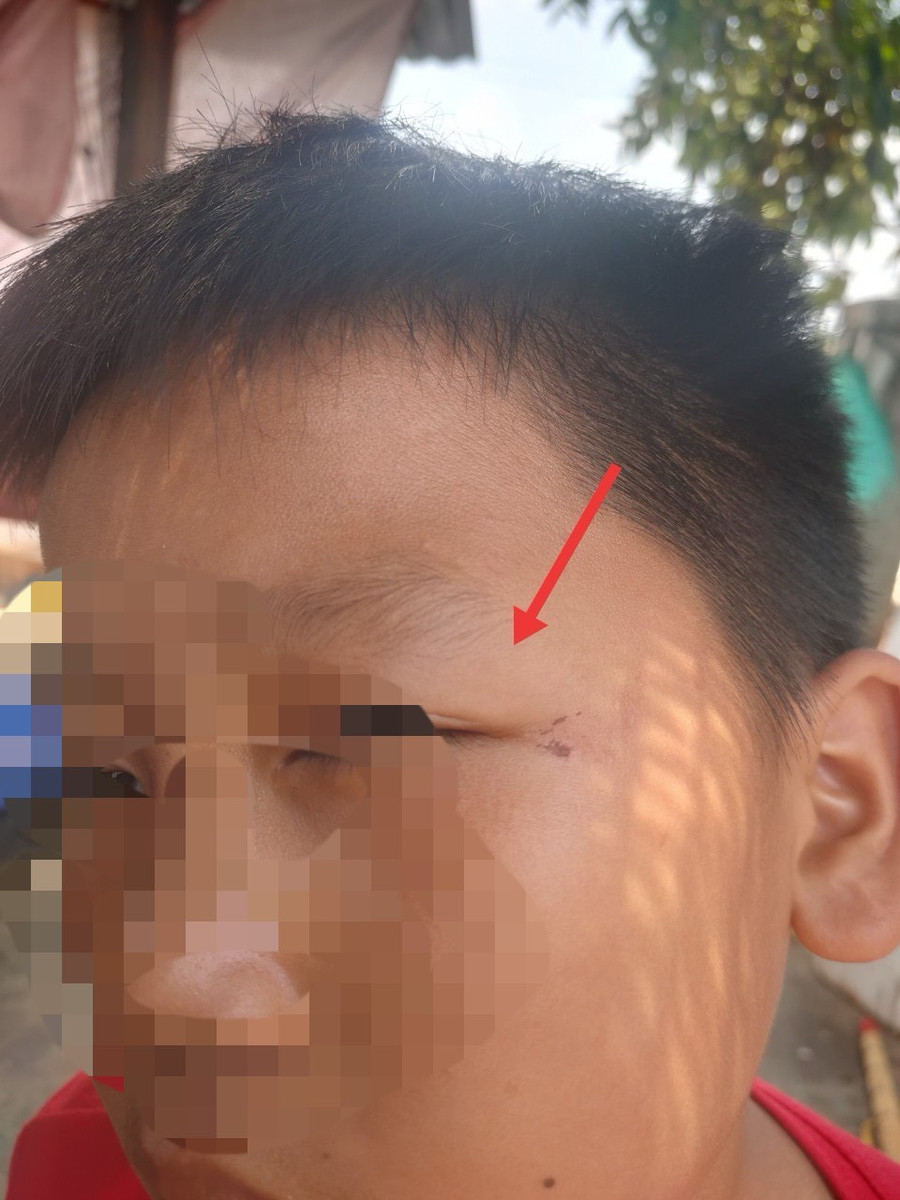 Một cháu nhỏ bị thương ở vùng mặt. (Ảnh: TD)