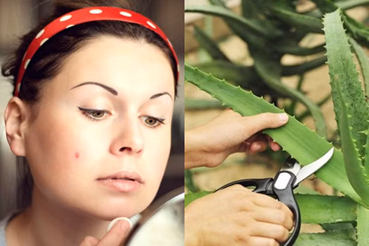 12 mẹo nhỏ làm mờ thâm sẹo do mụn trứng cá ngay tại nhà