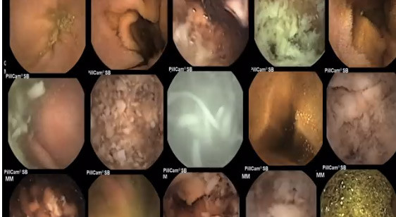 Những bức hình chụp trong dạ dày ghi nhận quá trình tiêu hoá mỳ tôm và mỳ tự làm