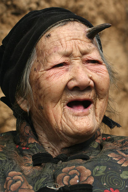 Bà lão 101 tuổi Zhang Duifang ở Hà Nam, Trung Quốc bỗng dưng mọc sừng A 101-year-old woman named Zhang Duifang is pictured with a tumour on her forehead in the shape of a horn, in Lushan Country, Henan Province, China