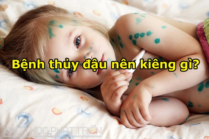 Bị bệnh thủy đậu kiêng ăn, uống thứ gì?