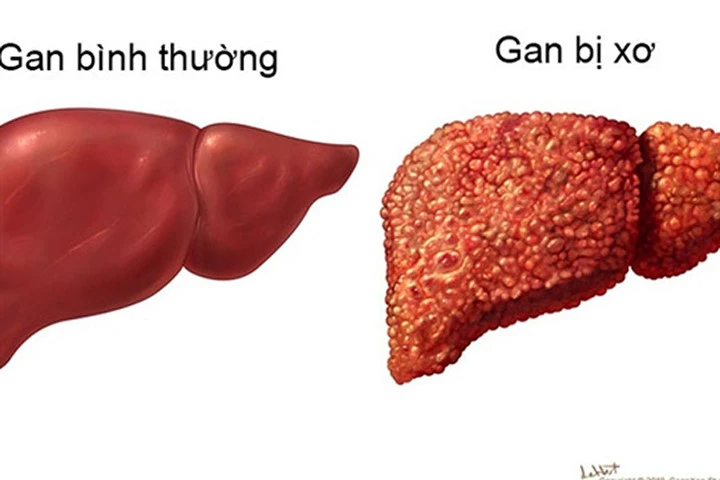 5 dấu hiệu của bệnh xơ gan ai đã có thì nên khám ngay kẻo muộn