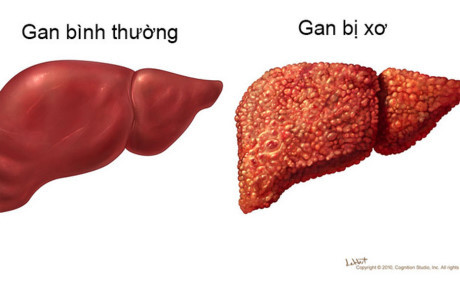 5 dấu hiệu của bệnh xơ gan ai đã có thì nên khám ngay kẻo muộn - Ảnh 1 5 dau hieu cua benh xo gan ai da co thi nen kham ngay keo muon - Anh 1