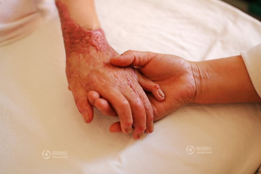 Bàn tay sần sùi đầy sẹo