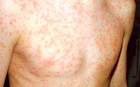 Dấu hiệu nhận biết bệnh sởi