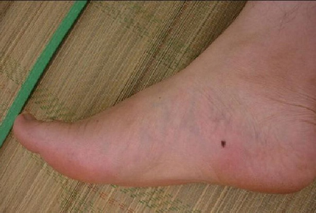 Nốt ruồi bàn chân có ý nghĩa gì, sang hèn lành dữ ra sao? - Ảnh 3.