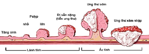 Những điều cần biết để phòng trị ung thư đại tràng