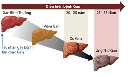 Kinh hãi hình ảnh gan biến dạng vì rượu, bác sĩ giật mình