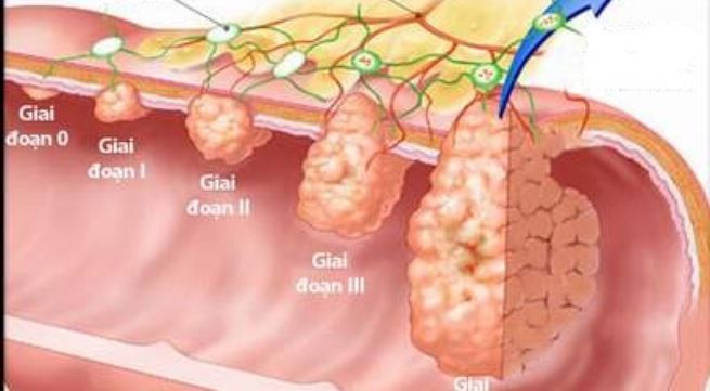 Các giai đoạn của ung thư đại tràng.