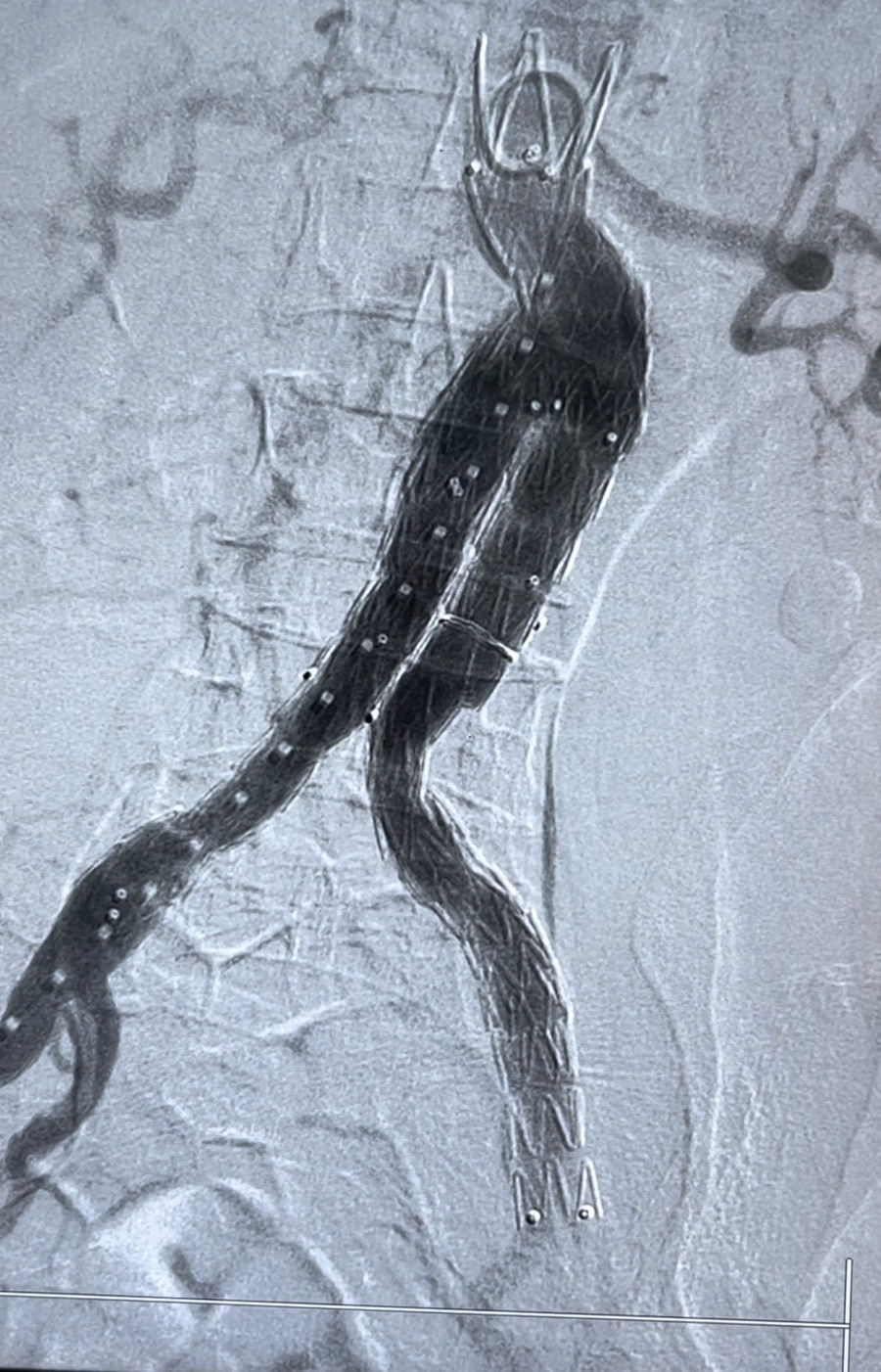 Hình ảnh sau khi can thiệp, túi phình lớn động mạch chủ bụng đã trở lại bình thường. Hình ảnh sau khi can thiệp, túi phình lớn động mạch chủ bụng đã trở lại bình thường.