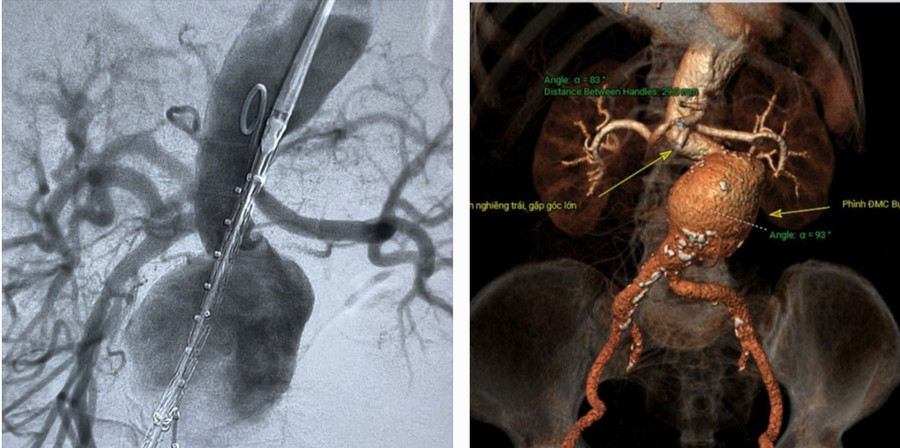 Hình ảnh túi phình lớn động mạch chủ bụng nguy cơ vỡ rất cao trước can thiệp. Hình ảnh túi phình lớn động mạch chủ bụng nguy cơ vỡ rất cao trước can thiệp.