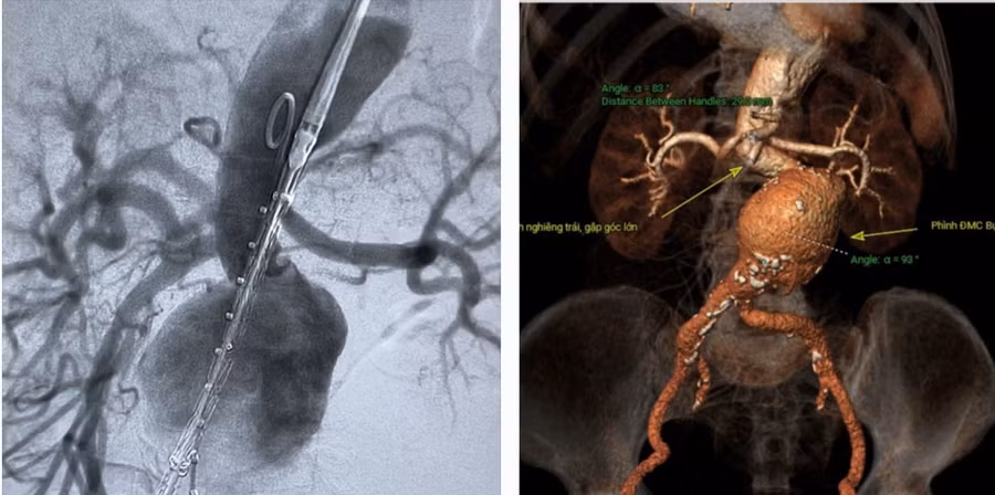 Hình ảnh túi phình lớn động mạch chủ bụng nguy cơ vỡ rất cao trước can thiệp.