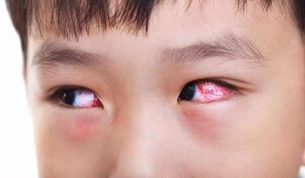 Dịch đau mắt đỏ ở Thừa Thiên - Huế đang tăng nhanh trong khối học sinh. (Ảnh: minh họa).