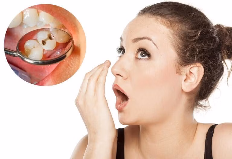 Sâu răng, răng khôn mọc lệch khiến hơi thở nồng mùi