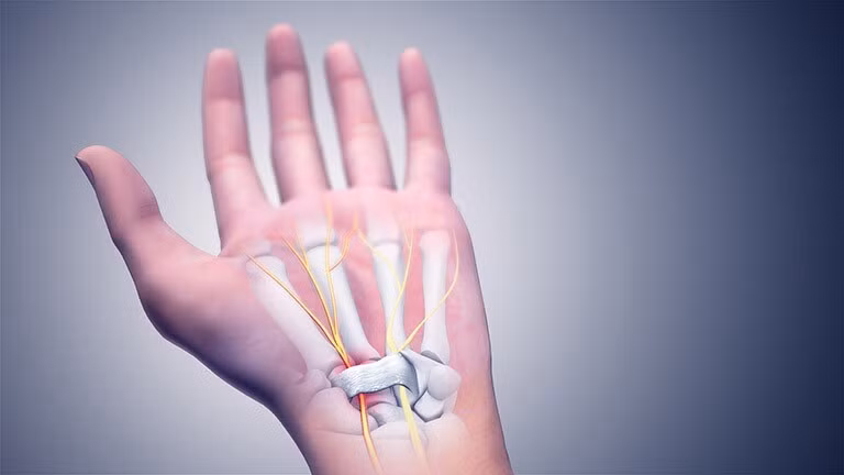 Dây thần kinh cổ tay bị chèn ép gây nên hội chứng ống cổ tay