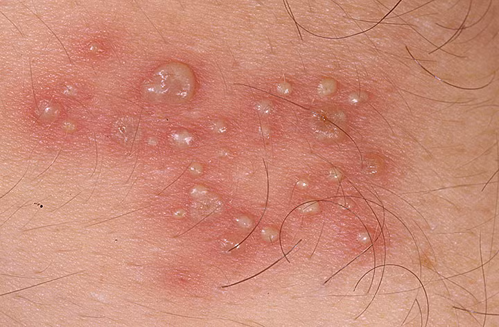 Đừng coi thường bệnh mụn rộp sinh dục