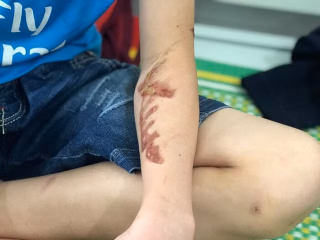 Những vết thương trên người em D. do chủ quán bánh xèo gây ra