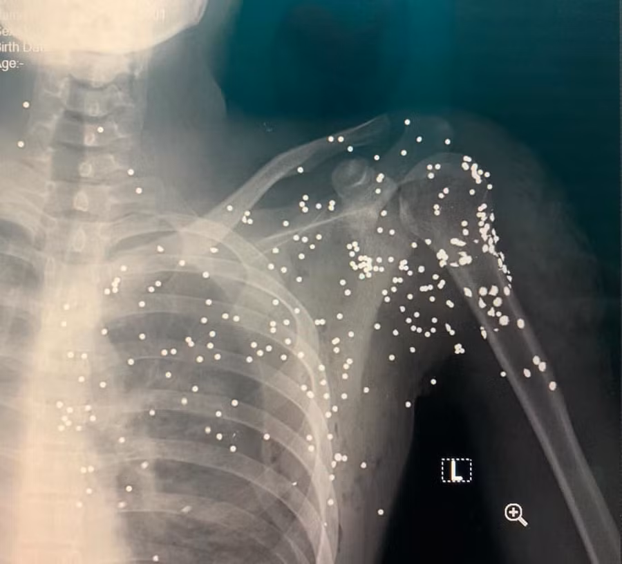 Hình chụp X-quang cho thấy vết thương trên người nạn nhân