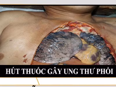 Sự thật kinh hoàng về tác tại của thuốc lá với bệnh hô hấp