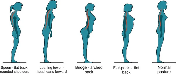 Nhìn tư thế có thể biết bạn có nguy cơ bị đau lưng không