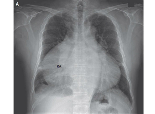 
Ảnh chụp X-quang cho thấy trái tim chiếm 82% lồng ngực bệnh nhân. Ảnh:The New England Journal of Medicine.