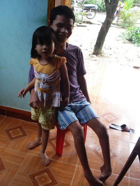 Cháu Ngọc có 24 ngón tay chân và Chú ruột của Ngọc cũng bị teo cơ ở chân và tay Cháu Ngọc có 24 ngón tay chân và Chú ruột của Ngọc cũng bị teo cơ ở chân và tay