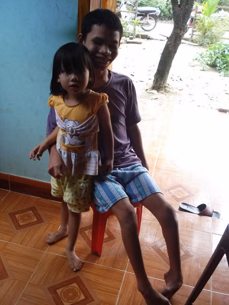 Cháu Ngọc có 24 ngón tay chân và Chú ruột của Ngọc cũng bị teo cơ ở chân và tay