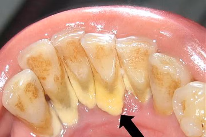 2 phút buổi tối sạch vĩnh viễn cao răng mà không mất tiền