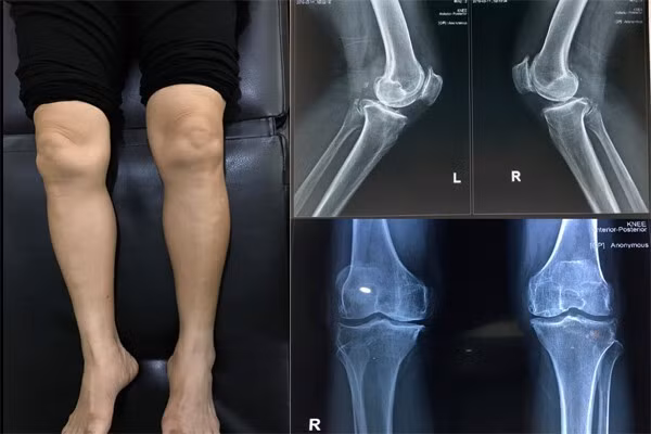 Đau nhức khớp gối ở người già có thể gây biến dạng khớp