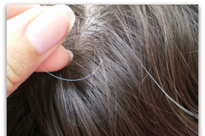 Nhìn vị trí tóc bạc sớm đoán nhiều bệnh nan y