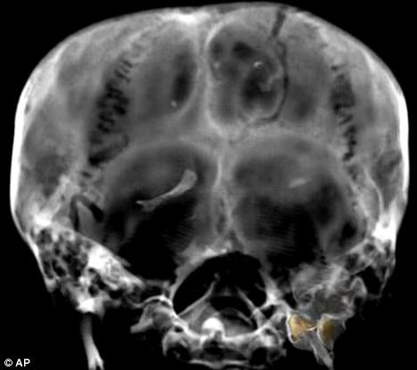 Hình ảnh hộp sọ vua Tut được quét cắt lớp chụp năm 2005 This photo shows a CT scan from 2005 of the skull of King Tutankhamun’s mummy, in Luxor. He suffered from a cleft palate and club foot, likely forcing him to walk with a cane Read more: http://www.dailymail.co.uk/sciencetech/article-1251476/King-Tutankhamun-died-broken-leg-worse-malaria.html#ixzz0fn71xGl8
