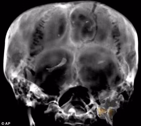 This photo shows a CT scan from 2005 of the skull of King Tutankhamun’s mummy, in Luxor. He suffered from a cleft palate and club foot, likely forcing him to walk with a cane Read more: http://www.dailymail.co.uk/sciencetech/article-1251476/King-Tutankhamun-died-broken-leg-worse-malaria.html#ixzz0fn71xGl8