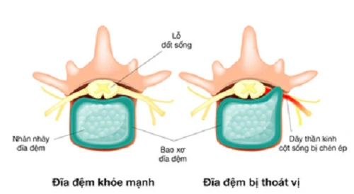 
Thoát vị đĩa đệm do vận động quá mức hoặc quá trình lão hóa tự nhiên của cơ thể. Ảnh:Maple Healthcare.