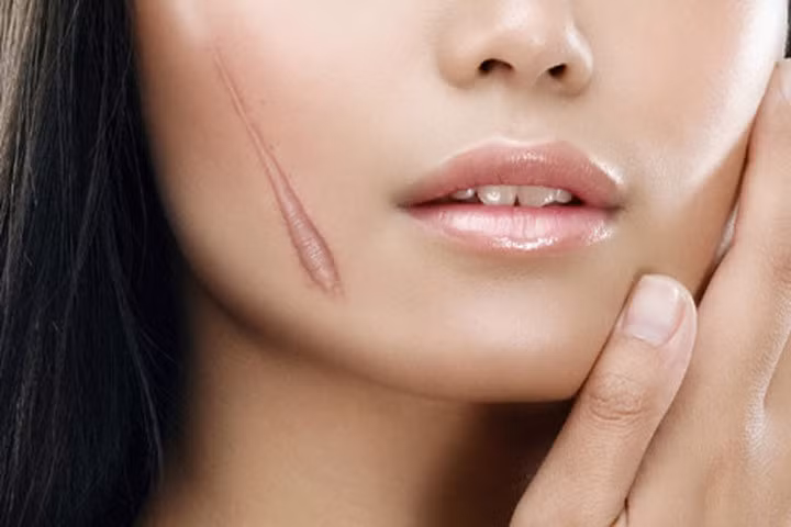 Những thực phẩm bạn cần nói "không" để tránh bị sẹo xấu xí