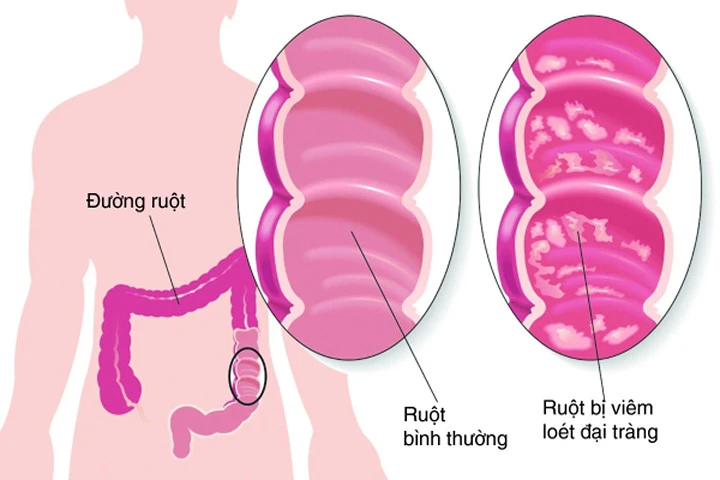 Viêm đại tràng mạn tính: Dễ mắc nhưng khó chữa