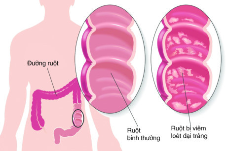 Viêm đại tràng mạn tính: Dễ mắc nhưng khó chữa - Ảnh 1 Viem dai trang man tinh: De mac nhung kho chua - Anh 1