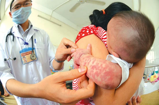 Nhiễm Enterovirus là một trong những nguyên nhân gây sốt phát ban ở trẻ.