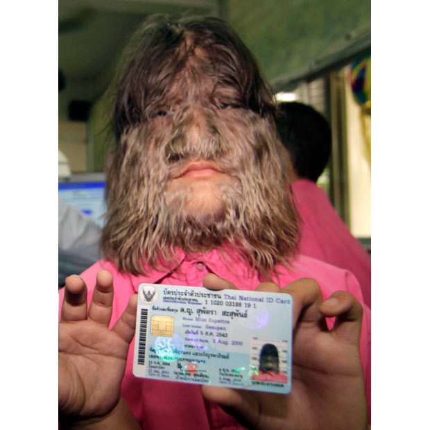 Thai school girl Supattra Sasupan, 11, the world’s hairiest girl, shows her national ID card during the first day of issuing ID cards to children aged seven to 14 nationwide at a school in Bangkok. Supattra has the very rare Ambras syndrome or Congenital Hypertrichosis meaning she has excessive hair covering her face and parts of her body.