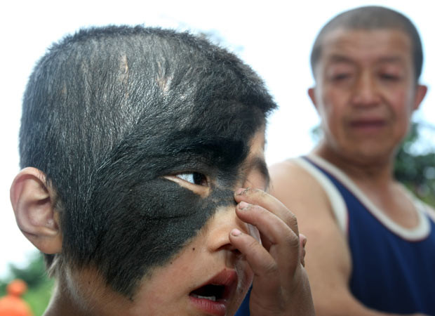 An eight-year-old Chinese boy who has a large birthmark covering one side of his face is to receive free surgery to remove it. An Qi was born with the large birthmark, which covers the right side of his face. As he has grown older the mark has grown further and also grown thick black hair. Min Yi Plastic Surgery Hospital in Changchun has now agreed to waive its treatment fee. Zheng Xiaoqin, president of the hospital, said it’s rare to have such a large hairy mole on the face and An’s treatment will be in four steps.
