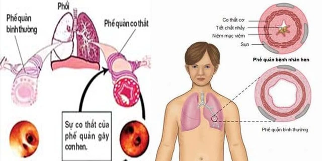 Hen phế quản hay gặp khi thay đổi thời tiết.