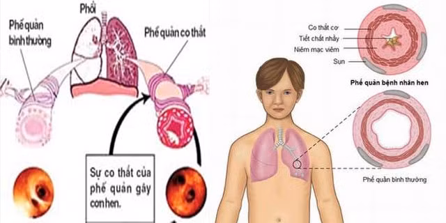 Hen phế quản hay gặp khi thay đổi thời tiết.