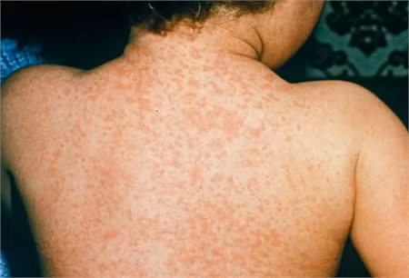 Nhận biết sởi với sốt phát ban