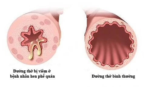 6 lời khuyên giúp phòng hen phế quản khi giao mùa