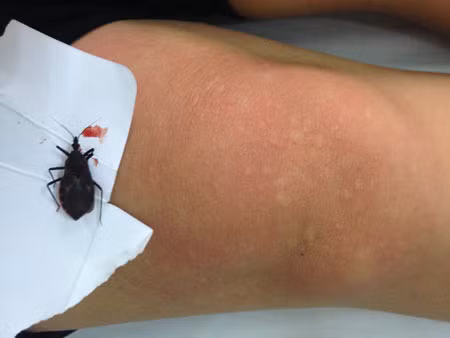 Bệnh nhân nổi mề đay, mẩn ngứa toàn thân, tăng nhịp tim sau khi bị bọ xít đốt. Ảnh: BS cung cấp.