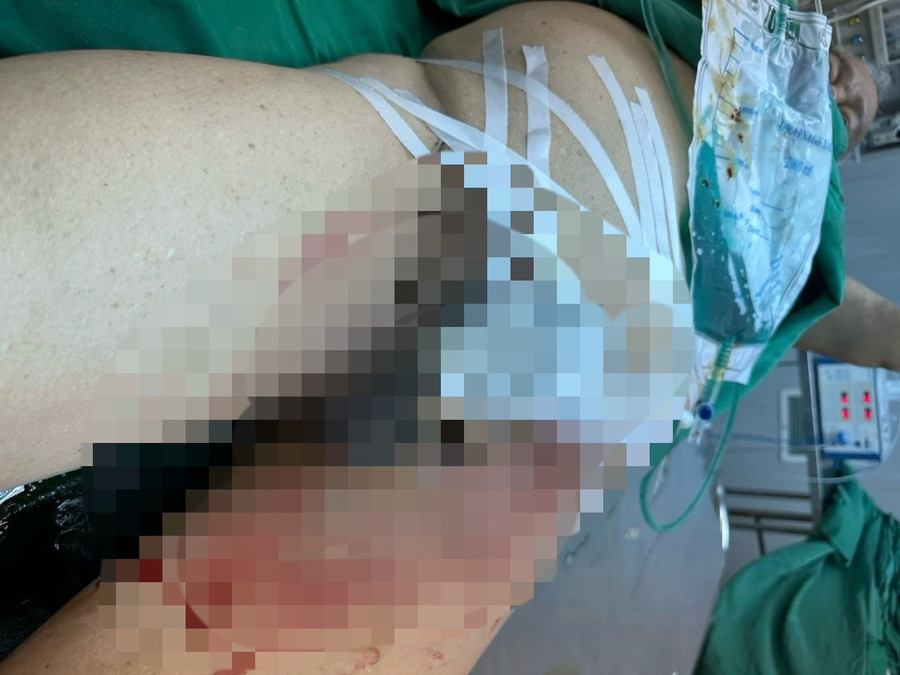 Bệnh nhân được phẫu thuật nối thành công dương vật bị đứt lìa. (Ảnh: TT)