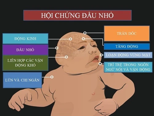 Những di chứng của virus Zika trên trẻ sơ sinh.Ảnh:MĐTT.