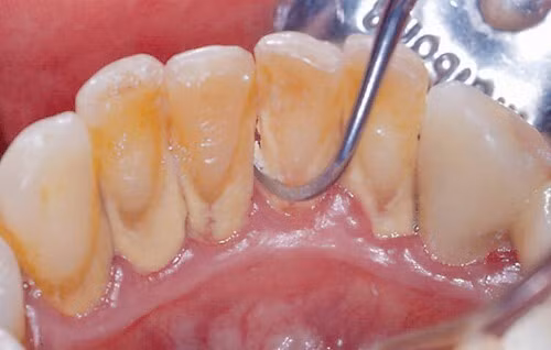 Mảng bám trên răng là nguyên nhân gây viêm lợi