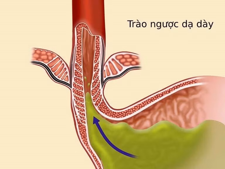 Nguyên nhân ăn không tiêu ợ chua thường xuyên và cách chữa đơn giản ảnh 3