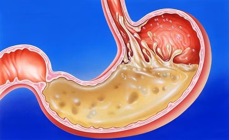 Nguyên nhân ăn không tiêu ợ chua thường xuyên và cách chữa đơn giản ảnh 1