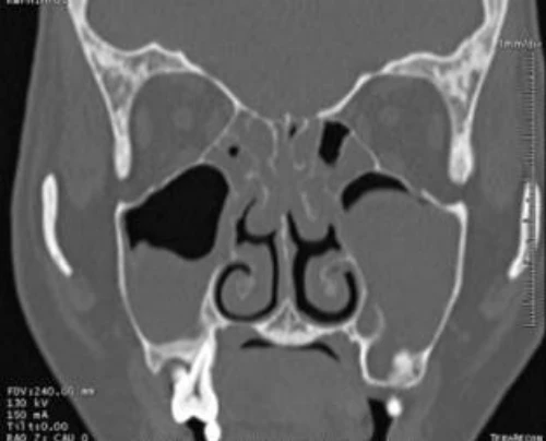 CT scan mũi xoang. 